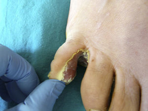 Intense erythema and maceration, with peripheral peeling in the fourth interdigital space.