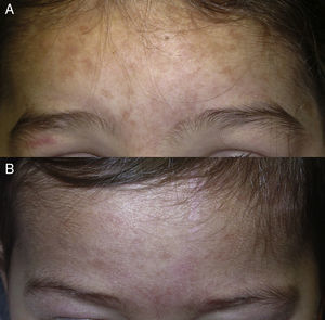 A, Hyperpigmented macules in the frontotemporal region of a 3-year-old white girl. B, The same lesions in her 2-year-old sister.