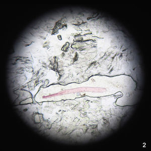 Direct optical microscopy examination of the adhesive tape test, showing pink fibrillary structures (original magnification x40).