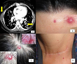 A, Computed tomography of the chest. Pulmonary metastases, mediastinal conglomerate mass of lymph nodes, as well as a mass of soft tissues on the right side. B-D, Red-violaceous lesions in the frontal region, the scalp, and in the proximity of the thyroidectomy scar. Thick, branched vascular structures in dermoscopy of a nodular lesion on the scalp.