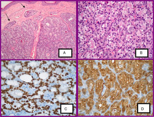 A, Histologic lesion of the scalp. Epithelial nodules surrounded by fibrosis and lymphatic invasion of tumor cells (hematoxylin-eosin [H-E], ×40). B, Follicular structures lined by round cells with clear cytoplasm and pleomorphic nuclei (H-E, ×100). C, TTF-1 positive (immunohistochemical staining). D, Galectine-3 positive (immunohistochemical staining).