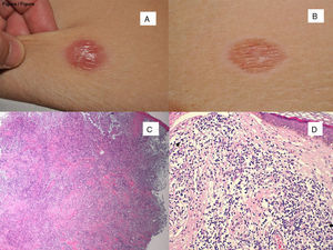 Clinical images of the lesion. A, At the first visit. B, 2 months later, with self-resolution. Histological appearance of the biopsies corresponding to the clinical images immediately above, with partial reduction of the tumor infiltrate in the second of them. C, Hematoxylin-eosin (H-E), x40. D, H-E, x400.