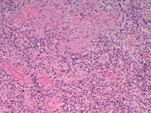 Histological appearance. Of note is the presence of numerous multinucleated gigant cells (H-E, x200).