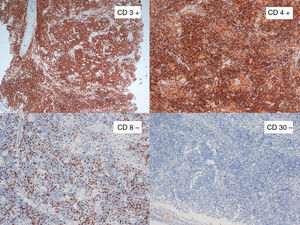In the immunohistochemical study, of note was positivity for CD3 and CD4 in the upper images and negativity for CD8 and CD30 in the lower ones. The limited staining for CD8 corresponds to accompanying cellularity and not tumoral cellularity.