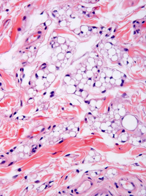 Multivacuolated and univacuolated lipoblasts constitute most of the dermal fat tissue. Mature adipocytes are scant (hematoxylin and eosin, original magnification ×200).