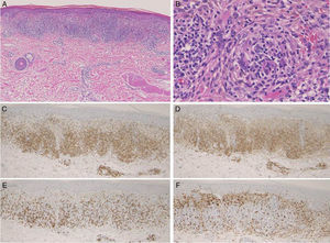 (A) Histological features showing focal dense cellular infiltrates in the upper dermis. (B) Higher magnification showed lymphohistiocytic infiltration with giant cells. The immunohistochemistry study revealed a number of CD3+ (C), CD4+ (D), CD8+ (E), and CD68+ (F) cells.