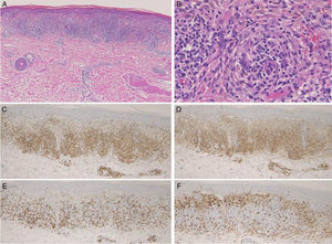 (A) Histological features showing focal dense cellular infiltrates in the upper dermis. (B) Higher magnification showed lymphohistiocytic infiltration with giant cells. The immunohistochemistry study revealed a number of CD3+ (C), CD4+ (D), CD8+ (E), and CD68+ (F) cells.