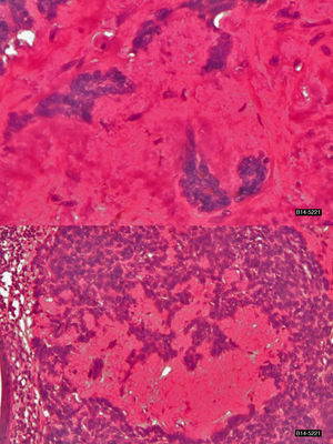 Basal cell carcinoma with a cylindromatous pattern. Both images show various tumor areas characterized by the presence of amorphous, hyaline material surrounded by basal cells with mild-to-moderate atypia (hematoxylin-eosin, original magnification ×200 and ×400).