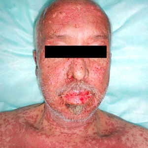Erythematous-edematous plaques with areas of skin detachment and erosive semimucosal lesions on the lips.