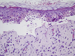 Skin detachment and epidermal necrosis with dyskeratotic keratinocytes and lymphocytic inflammatory infiltrate (hematoxylin-eosin, original magnification ×10).
