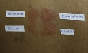 Patch test in a patient sensitized to allergens other than corticosteroids, such as ethylenediamine and palladium.