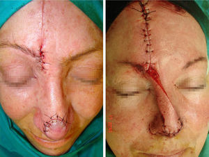 Paramedian forehead flap. Second stage: division of the pedicle and closure of the residual defect.