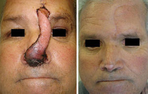Complications: superficial necrosis in a patient who smoked heavily. The necrosis resolved with conservative treatment, leaving an area of secondary hypopigmentation.