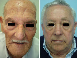 Good cosmetic results of the paramedian forehead flap. Presence of a secondary scar on the forehead.