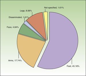 Distribution of Sample According to Sites of Chronic Hand Eczema Other Than the Hands.
