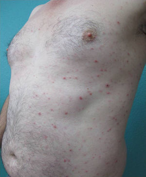 Rash consisting of multiple reddish-brown scaling papules, at different stages of development, on the trunk.
