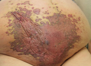 Large bruise-like reddish-purple plaque covering nearly the entire lower half of the abdomen.