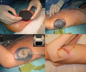 Negative pressure wound therapy (NPWT) system. A, Coverage of skin defect with foam. B, Placement of adhesive film over the foam to seal the system. C, Placement of vacuum tube connected to NPWT system. D, Reconstruction of surgical defect with Limberg flap.