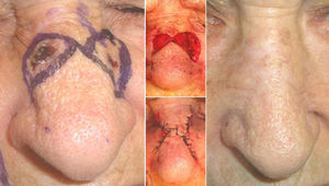 Burow triangle advancement flap for the excision of 2 adjacent tumors on the dorsum of the nose.