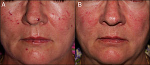 A, Mucocutaneous telangiectases on the nose, cheeks, and lips of patient #2. B, Excellent clearance of lesions after 4 treatment sessions.
