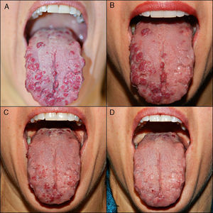 A, Multiple telangiectases, with episodes of spontaneous bleeding, on the tongue of patient #9. B, Result of 1 treatment session, in which the left dorsum and lateral surface of the tongue were treated. Note the difference with respect to the right, untreated side. C, Result after 2 sessions, with treatment of the whole surface of the tongue. D, Result after 3 treatment sessions. Note the excellent clearance achieved.