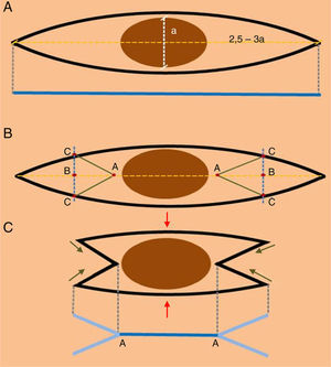 (A) The design of an elliptical excision. The blue line indicates the length of the surgical scar after closure. (B) Design of the double M-plasty. (C) Excision of the double M-plasty (the red arrows indicate closure of the central area, green arrows indicate the closure of the ends of the scar, and the blue line A-A indicates the exact site where the suspicious lesion was located).