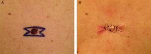 (A) Double M-plasty design for a suspected melanoma lesion. (B) Scar of the primary site of a malignant melanoma is clearly identifiable after a double M-plasty.