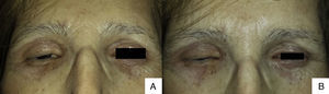 Erythema and infiltration of the 4 eyelids interfered with eye opening (A) and closure (B).