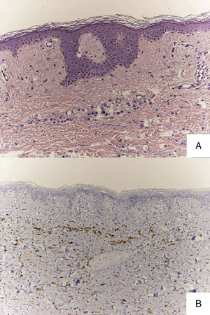A, Histology showing a dermal infiltrate of cords of cells from a lobular breast adenocarcinoma. Hematoxylin and eosin, original magnification×20. B, Immunohistochemistry showing groups of cells positive for GCDFP-15, indicating an origin in breast tissue. Original magnification×20.