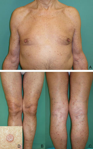 A-C, Multiple erythematous-brownish papules on the trunk and upper and lower extremities. D, Detail of a lesion on the left thigh, showing central atrophy with a well-defined, slightly elevated, keratotic border.