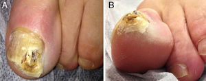 Hyperkeratotic tumor that has destroyed the distal lateral border of the nail of the left great toe: A, Superior view. B, Inferior-lateral view.