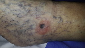 Clinical presentation. Elevated, asymmetric, dark blue and brown lesion with poorly defined borders and a diameter of 1cm; the lesion is surrounded by halo eczema with desquamation. Background of edema and varicose blood vessel dilatation.