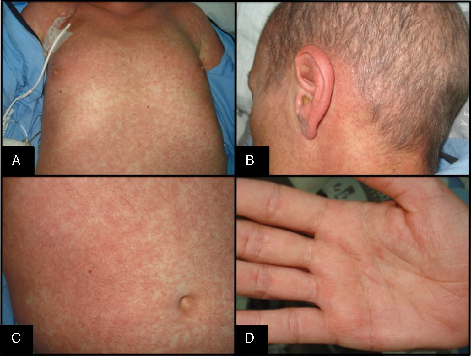 Graft versus host disease