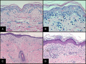Histopathology of cutaneous GVHD. A and B, Acute GVHD. Hematoxylin and eosin (H&E), original magnification ×200 and H&E, original magnification×400, respectively. Interface dermatitis with necrotic keratinocytes surrounded by lymphocytes (lymphocyte satellitosis). C and D, Chronic GVHD. H&E, original magnification×100 and H&E, original magnification×200. Interface dermatitis with dermal-epidermal detachment and follicular involvement.