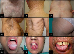 Signs of chronic cutaneous and mucosal graft-vs-host disease. A, Poikiloderma. B, Nongenital lichen sclerosus et atrophicus. C, Lichenoid eruption. D, Morphea. E, Fasciitis. F, Keratosis pilaris. G, Oral lichen planus. H, Oral erosion and ulcers. I, Hyperkeratosis and fissures.