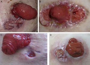 Clinical images. A, Case 1. Parastomal ulcer (maximum diameter, 3cm) with violaceous edges and cribriform scarring in a man aged 47 years with ulcerative colitis. B, Case 2. Peristomal ulcer (diameter, 5cm) with raised and violaceous edges in a woman aged 27 years with ulcerative colitis. C, Case 3. Small parastomal ulcer with punched out edges that first appeared 4 months previously in man aged 29 years with Crohn disease. D, Case 4. Parastomal ulcer (diameter, 2cm) with a fibrin-covered base in a man aged 79 years diagnosed with rectal carcinoma.