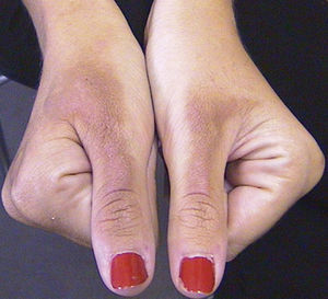 Asymptomatic, homogeneous hyperpigmentation that developed on the dorsum of the thumbs of both hands of a patient several days after preparing mojitos at a beach party.