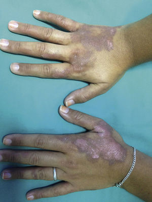 Irregular hyperpigmentation that developed on the dorsum of both hands of a patient 3 days after serving mojitos at a wedding and followed by intense sunlight exposure in adjacent gardens.