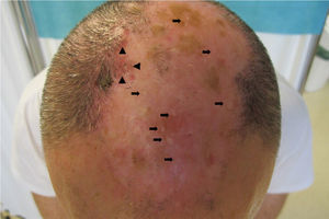 Plaque of scarring alopecia in the parietal area with numerous white papular lesions inside (, and papules and follicular pustules, and tufted hair folliculitis at the margins (▴).