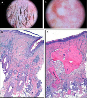 A, Dermoscopic image. Polytrichia, follicular pustules, and milky-red areas with loss of follicular orifices. B, In the dermis, chronic granulomatous-histiocytic inflammatory infiltrate in perifollicular regions (hematoxylin-eosin×100). C, Dermoscopic image. Whitish areas. D, Mature bone tissue with bone marrow immersed in dermal collagen and subcutaneous cell tissue (hematoxylin-eosin×100).