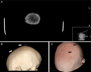 Head computed tomography. A, Punctiform cutaneous lesions with high attenuation. B, Three-dimensional image of frontal and parietal lesions. C, Surface 3-dimensional image, cutaneous site of lesions ().