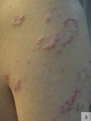 Nodular syphilis forming an arciform pattern on the arm (photograph courtesy of Dr Irene Fuertes).