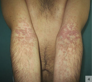 Annular syphilis in the elbow pits and on the forearms (photograph courtesy of Dr Enrique Herrera).