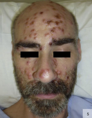 Generalized pustular syphilis. Detailed view of facial involvement (photograph courtesy of Dr Irene Fuertes).