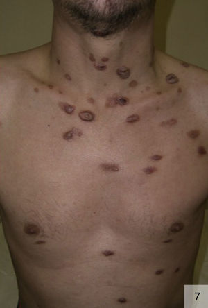Malignant syphilis in a patient with human immunodeficiency virus coinfection (photograph courtesy of Dr Vicente García-Patos).