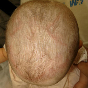 Annular Lesions on the Head of an Infant | Actas Dermo-Sifiliográficas