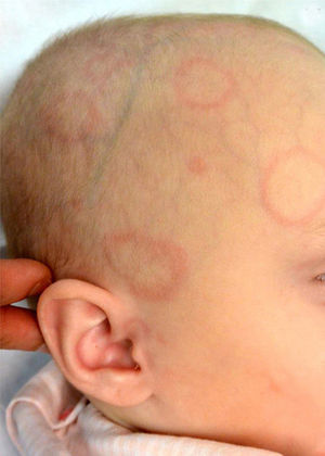 Annular Lesions on the Head of an Infant | Actas Dermo-Sifiliográficas