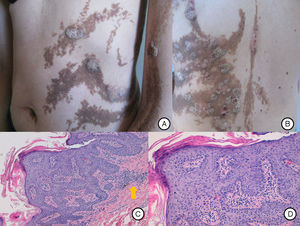 A, Inflammatory lesions over the epidermal nevus on the trunk and left upper limb. The lesions presented as round and oval plaques with a psoriasiform appearance. B, Patchy distribution of the inflammatory lesions on the patient's back, not affecting some areas of the epidermal nevus. C, Biopsy of 1 of the lesions showed epidermal nevus architecture with acanthosis and papillomatosis, associated with a lymphocytic infiltrate in the superficial dermis (arrow). Hematoxylin and eosin, original magnification×10. D, Area of parakeratosis with mild spongiosis. Hematoxylin and eosin, original magnification×20.