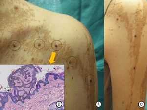 A and B, Pigmented macular lesions on the epidermal nevus in a linear distribution on the trunk and left upper limb. C, Biopsy of a pigmented macule on the trunk showed epidermal nevus architecture associated with junctional melanocyte hyperplasia, indicating the presence of a junctional lentiginous melanocytic nevus with no atypia. Hematoxylin and eosin, original magnification×10).