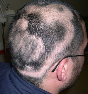 Concentric areas of alopecia and hair regrowth producing a targetoid pattern.
